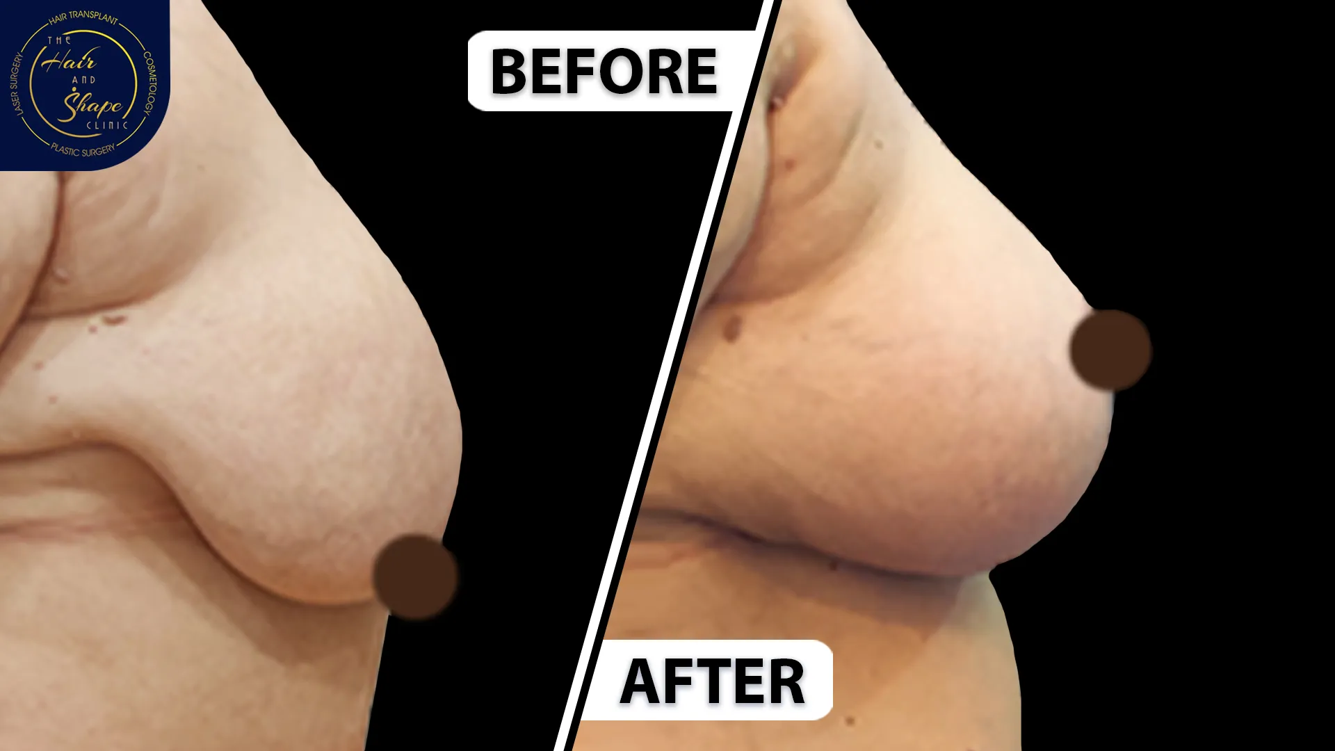 Breast Reduction result4